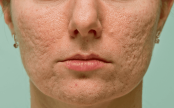 Tratamento para Cicatriz de Acne: Guia Completo