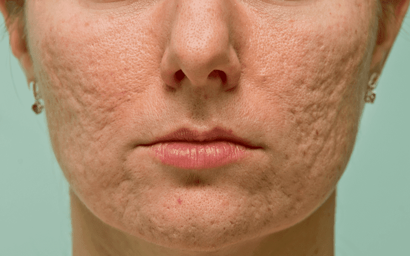 cicatriz de acne no rosto