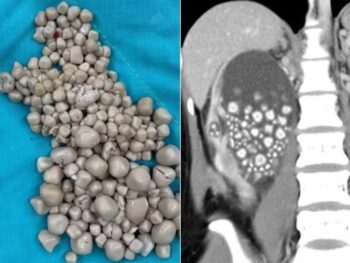 Quanto Tempo de Repouso Após Cirurgia de Pedra nos Rins ?